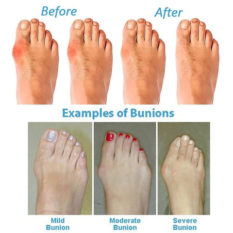 Feline Orthopädische Sandalen für Damen - Komfort und Unterstützung bei jedem Schritt